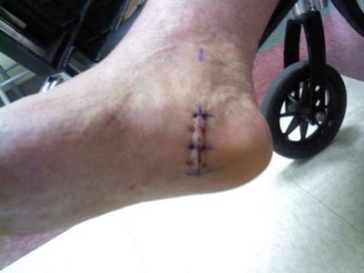 post surgery heel spur removal