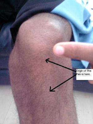 Is this pain in the knee from Jumpers Knee?