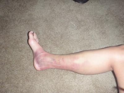 Picture of injury leading to myositis Ossificans, swelling, bruising, and pain