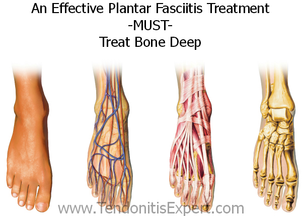 Plantar Fasciitis