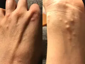 Recurring Small Ganglion Cysts