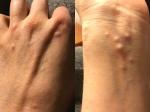 Recurring Small Ganglion Cysts