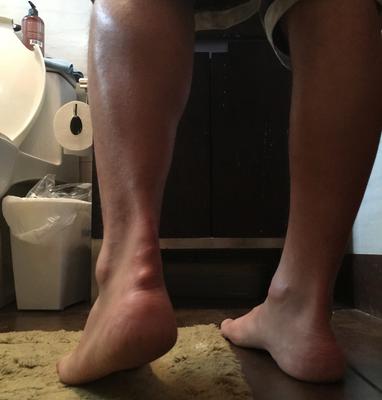 Achilles Tendon Cyst growing after achilles tendon rupture surgery