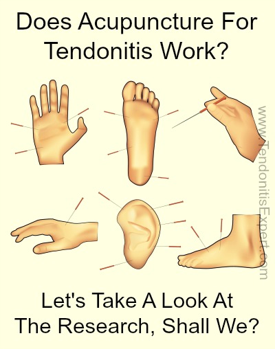 Does Acupuncture For Tendonitis Work?