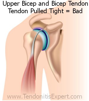 upper bicep tendon tendonitis anatomy graphic