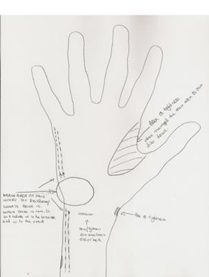 bilateral wrist tendonitis symptoms drawing