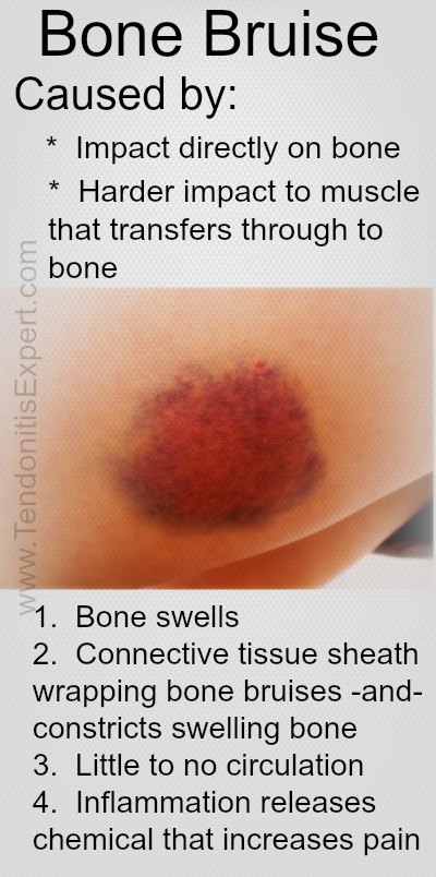 Bone Bruise, Bruised Bone,