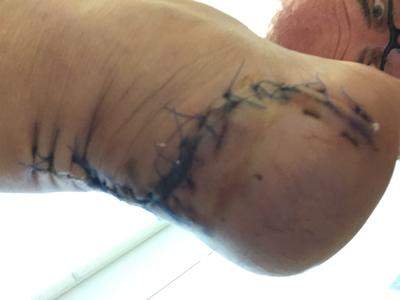Gnarly incision from achilles debridement surgery