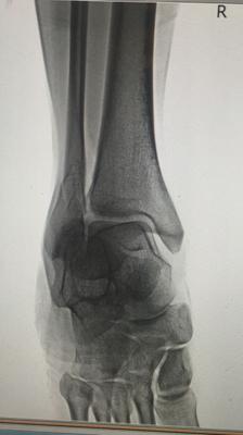 Xray 3 of broken fibula from low vitamin d 3ng/ml deficiency