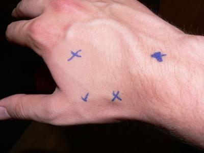  marking of pain on right wrist/hand