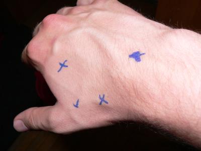  marking of pain on right wrist/hand 2