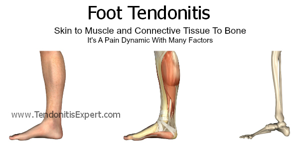 Tendonitis bottom sales of foot