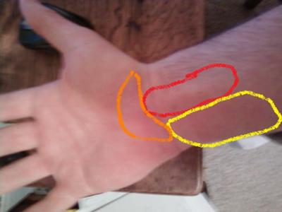 Guitar playing wrist pain picture - Yellow: where the pain started. Red: where dull pains are felt now. Orange:dull pains after writing for long periods of time