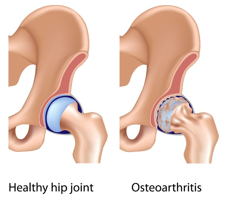 showing healthy hip joint and osteoarthritis side by side