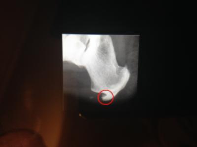 bone spur picture