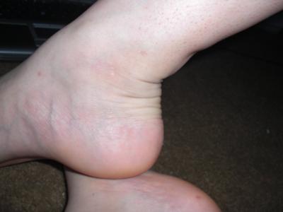see the achilles tendonitis lump? above the wrinkly bent part of the ankle