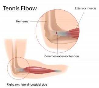 tennis elbow tendonitis anatomy picture