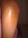 my elbow..showing swelling
