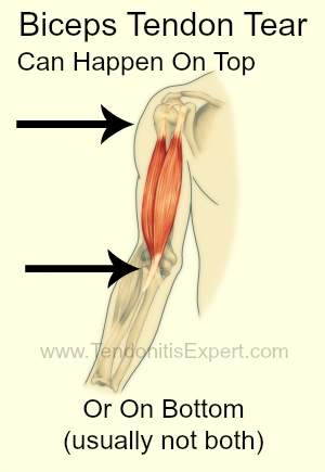 Torn Biceps Tendon Can Happen On Top Or Bottom