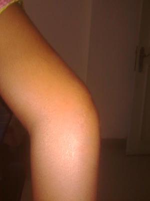 swelling of hypermobile elbow