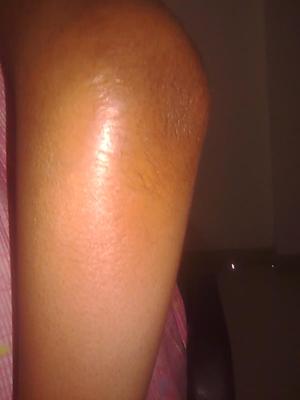 my elbow..showing swelling