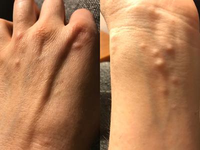 Recurring Small Ganglion Cysts