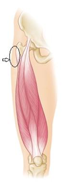 Pain at Anterior Inferior Iliac Spine