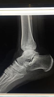 Xray 2 of broken fibula from low vitamin d 3ng/ml deficiency