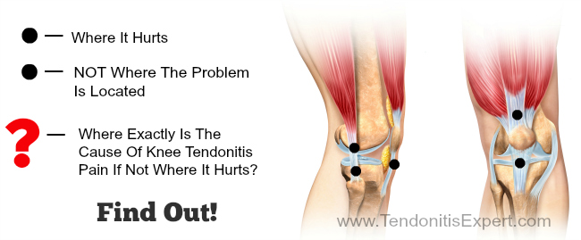 cause of knee tendonitis location picture graphic