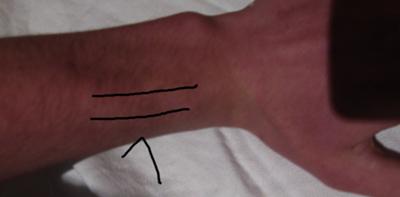 Tendon pain from playing guitar, back of wrist, image picture