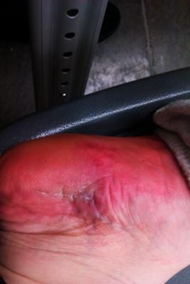 wound after plantar fasciitis surgery