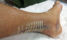 two days post Achilles tendon reattachment surgery picture