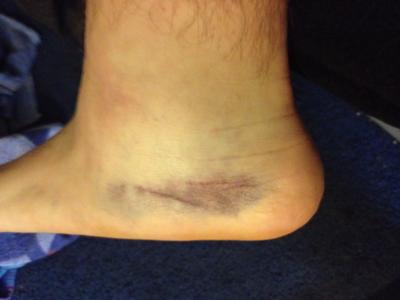 Pooling in ankle bruising from shin impact