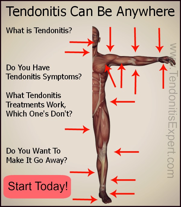 tendonitis can be anywhere