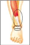 pain at top front of ankle