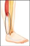 pain at back lateral side of lower leg