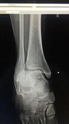 Xray 1 of broken fibula 