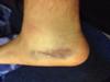 Pooling in ankle bruising from shin impact