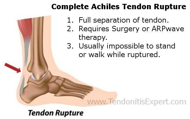 completely torn achilles tendon rupture graphic