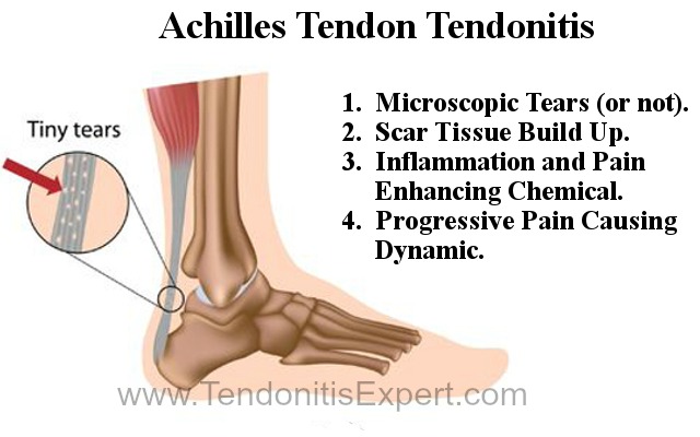 Torn achilles tendon page tendonitis graphic