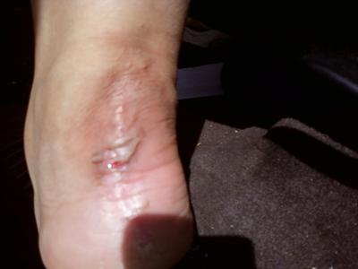 heel spurs and achilles tendonitis